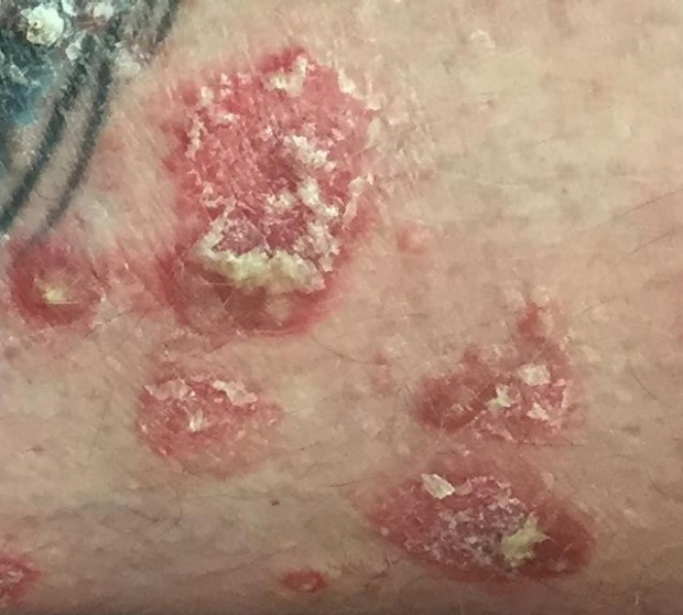scale from psoriasis